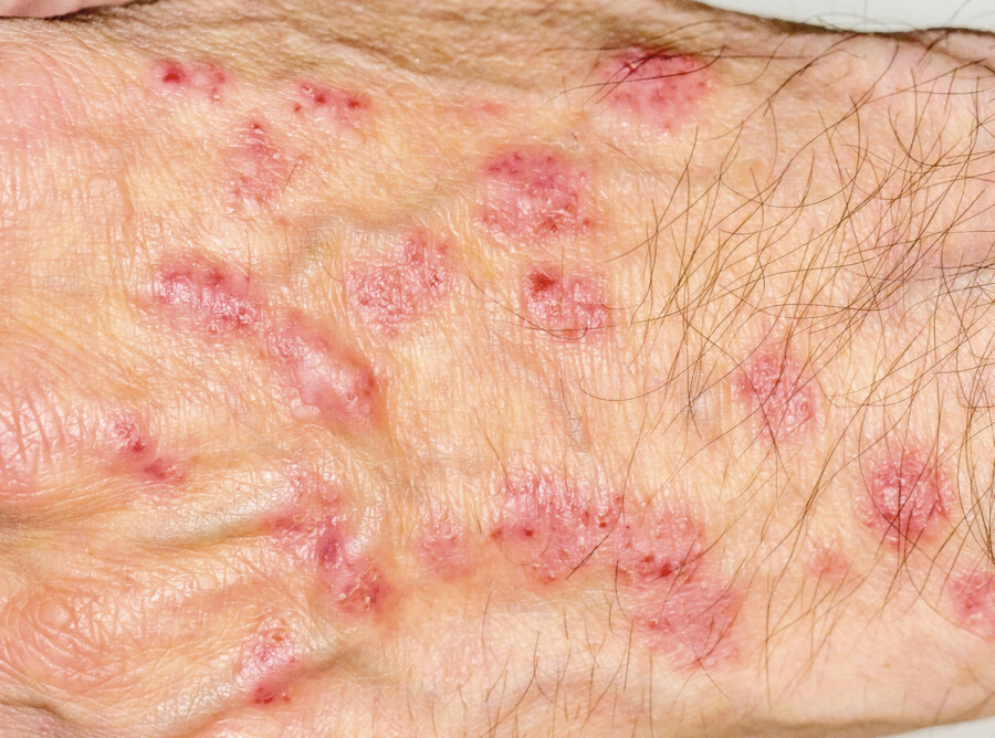 Psoriasis vulgaris.