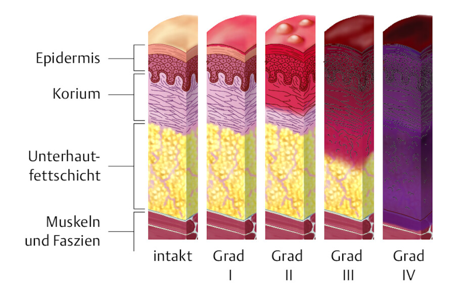 Unterschiedliche Verbrennungstiefen in der schematischen Darstellung.