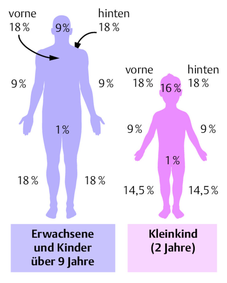 Neunerregel nach Wallace.