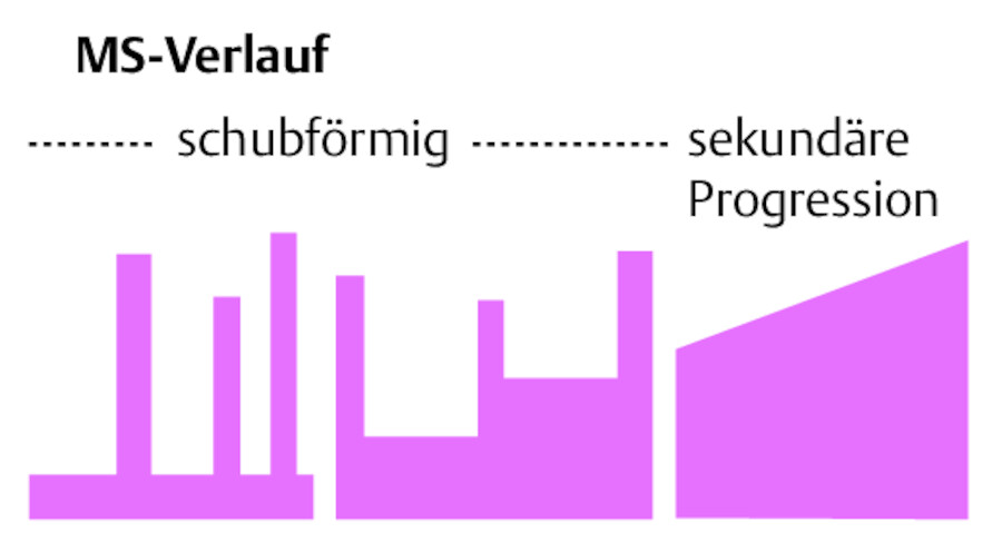 Verlaufstypen der MS.