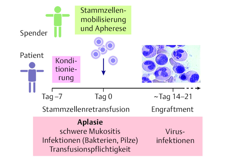 Ablauf der allogenen Stammzelltransplantation.