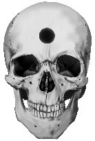 Drawing of a skull with a large hole in the middle of the forehead.