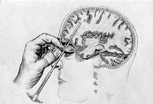 Drawing of a cutaway side view of somone receiving a lobotomy