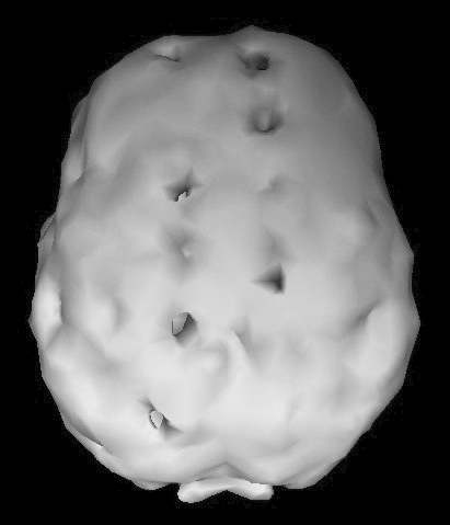 Surface SPECT scan showing areas of very low blood flow.