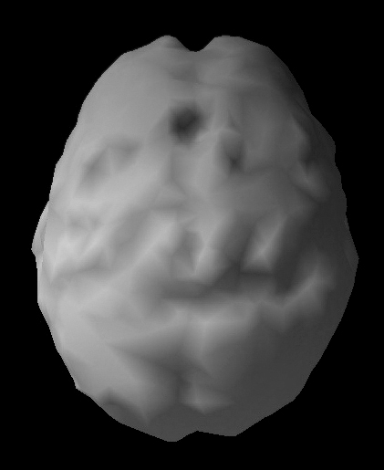 Surface SPECT scan showing mostly uniform blood flow.