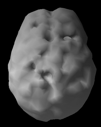 Surface SPECT scan showing areas of very low blood flow.