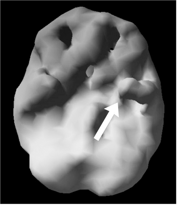 Surface SPECT scan showing areas of very low blood flow. An arrow points to a region on the right side of the scan halfway toward the back of the brain.