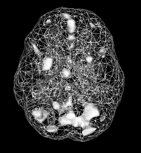 Active SPECT scan showing greater activity in scattered areas.