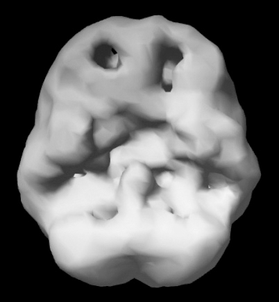 Surface SPECT scan showing areas of very low blood flow.