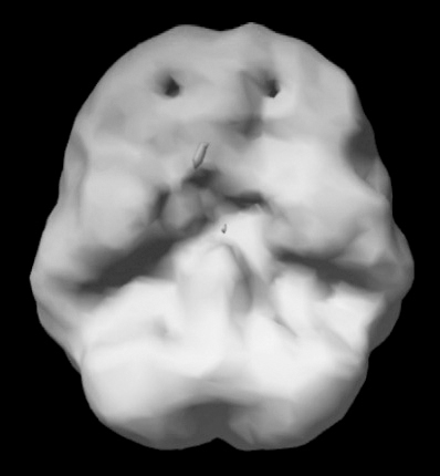 Surface SPECT scan showing more uniform blood flow.