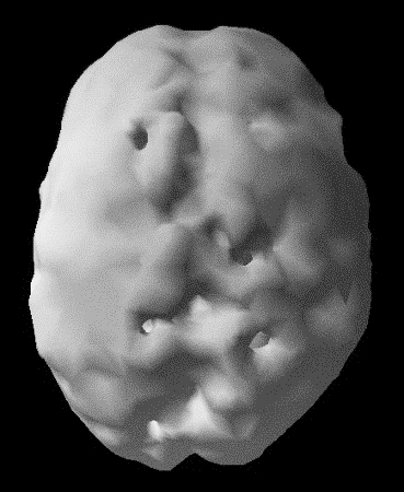 Surface SPECT scan showing areas of very low blood flow.