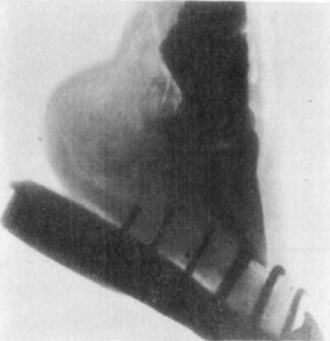 Fig. 39—Skiagraph of foot. The X-ray offers very limited possibilities in the diagnosis of lameness. The location of a ''gravel'' or a nail that had worked its way some distance from the surface, or of an abscess of some proportion, deep in the tissues, might be facilitated under some circumstances by the aid of the X-ray. Its use in the detention of fractures is very limited, owing to the difficulty encountered in getting a view from the right position—many trials being necessary in most cases. The case shown above was diagnosed clinically as incipient ringbone. The X-ray revealed no lesions. (Photo by L. Griessmann.)