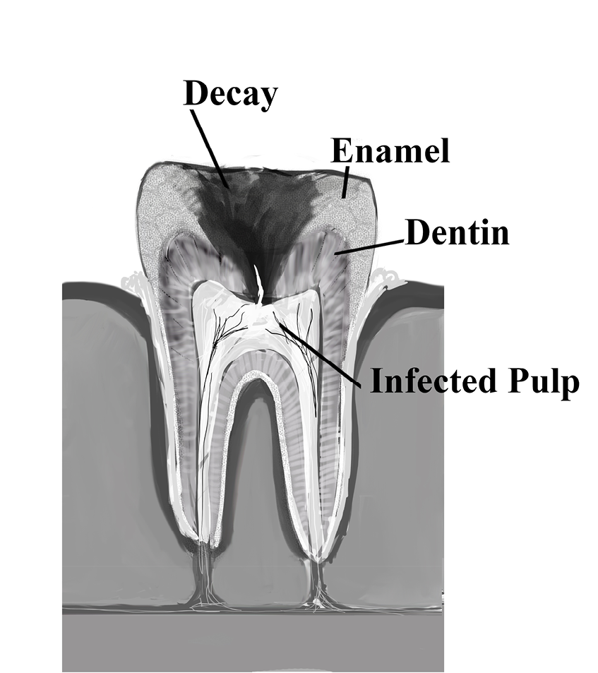 fig%2027-3--Tooth%20Decay%20Labelled.jpg