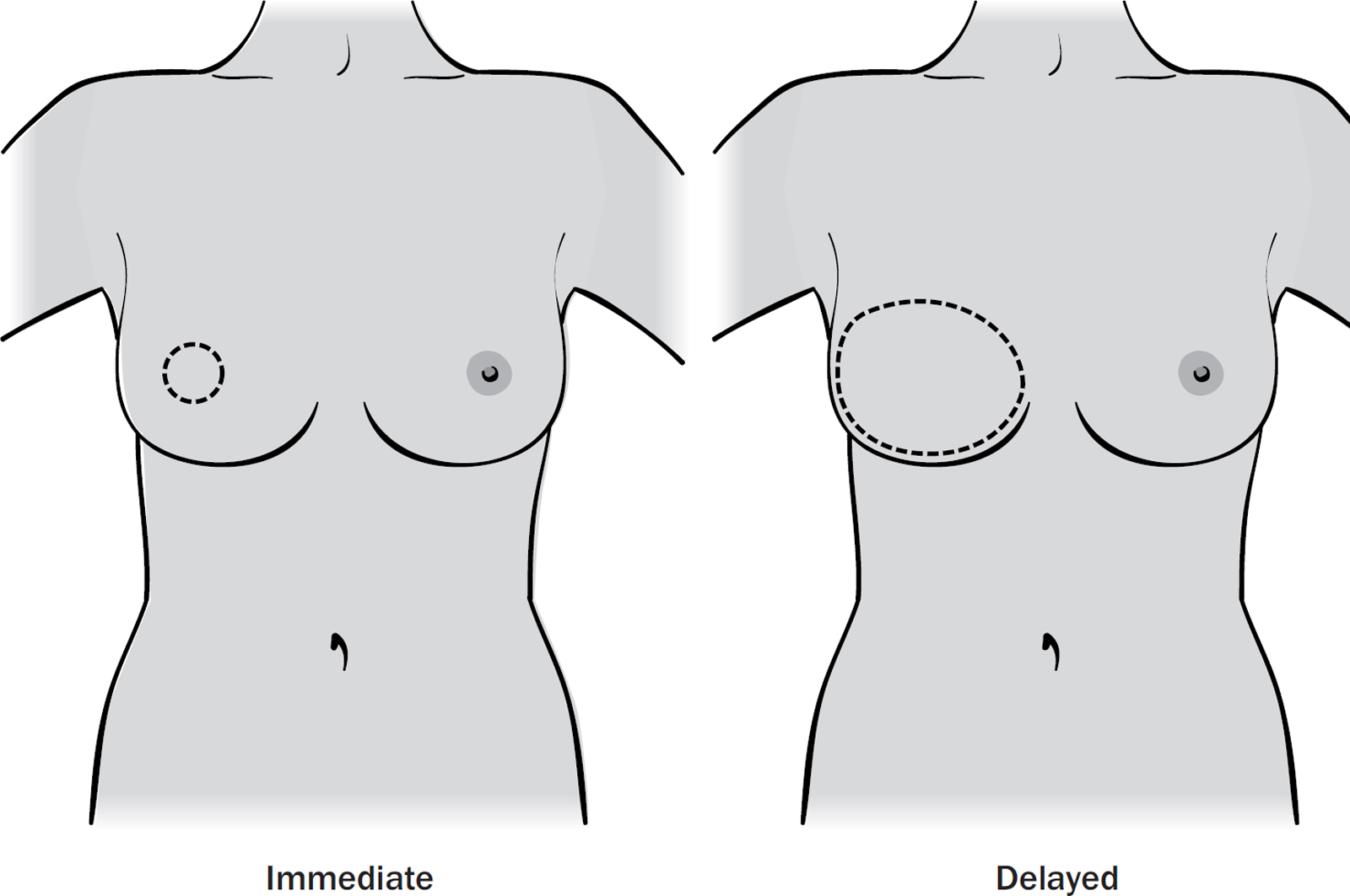 Breast reconstruction scars