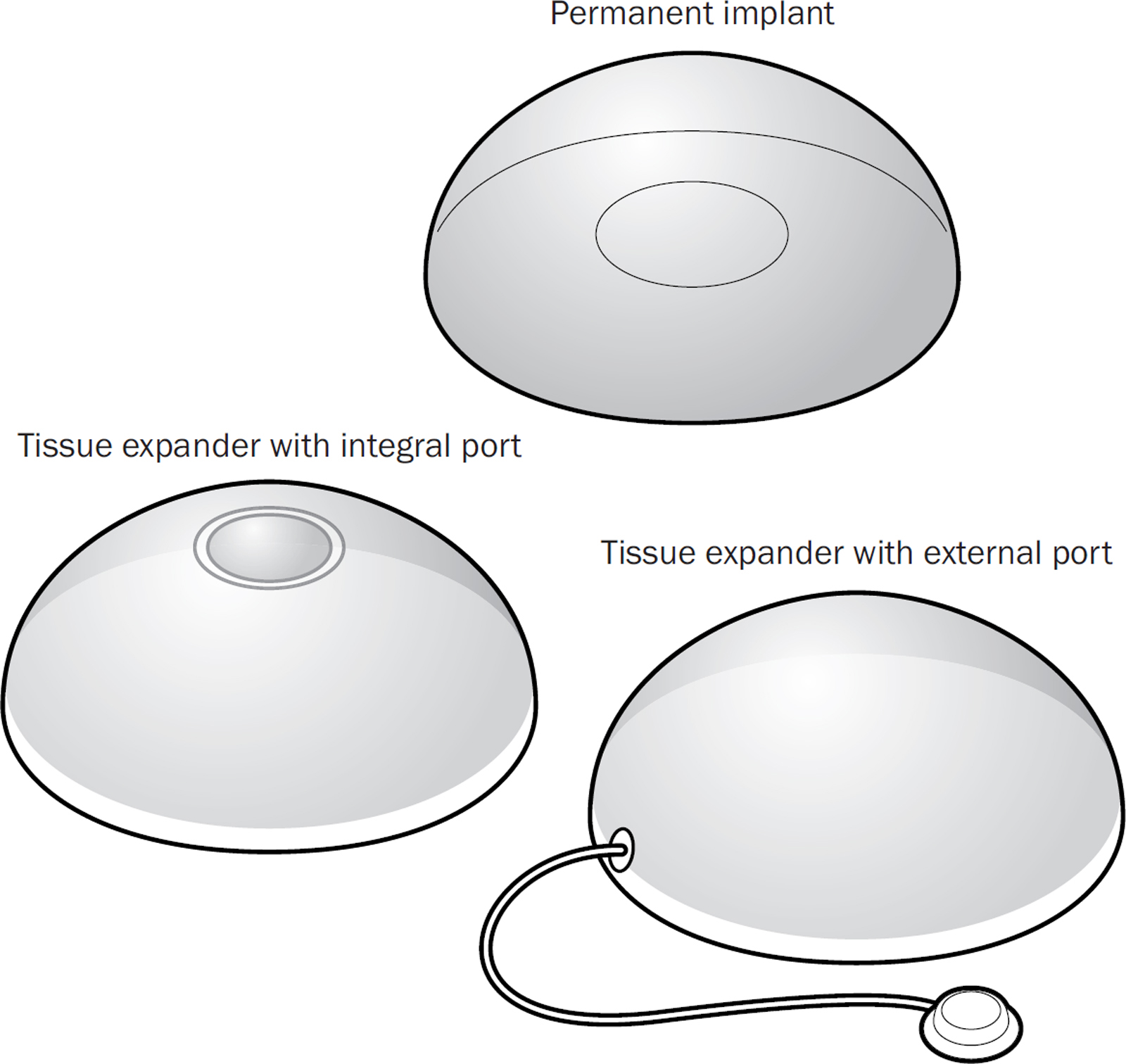 Types of breast implant