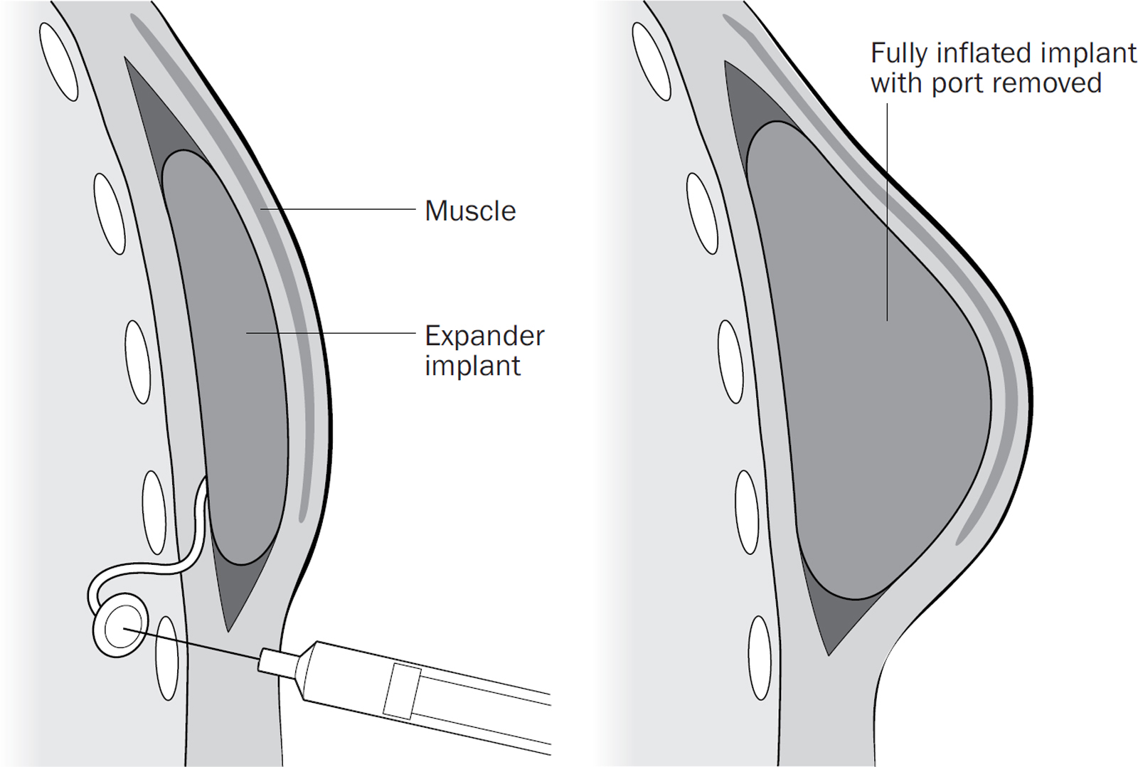 Expander implant reconstruction