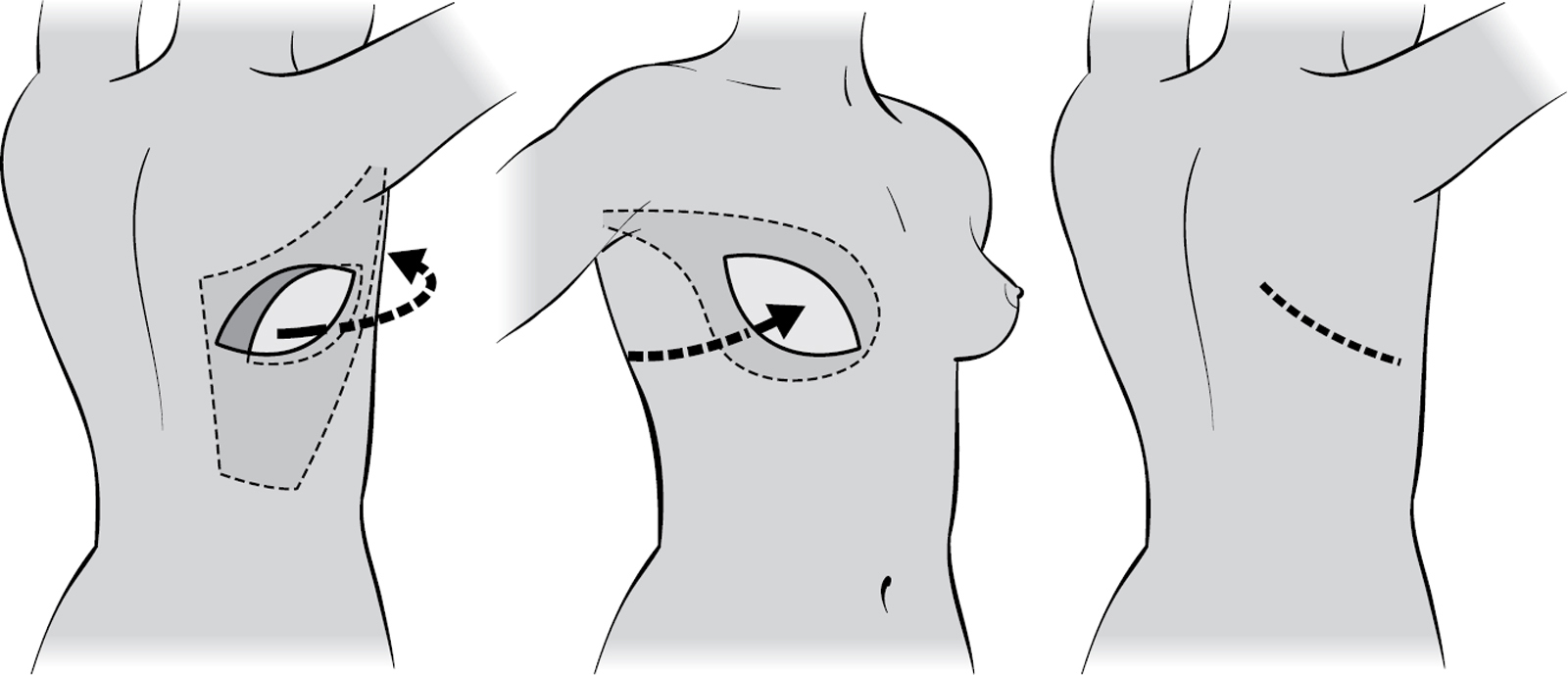 LD flap reconstruction