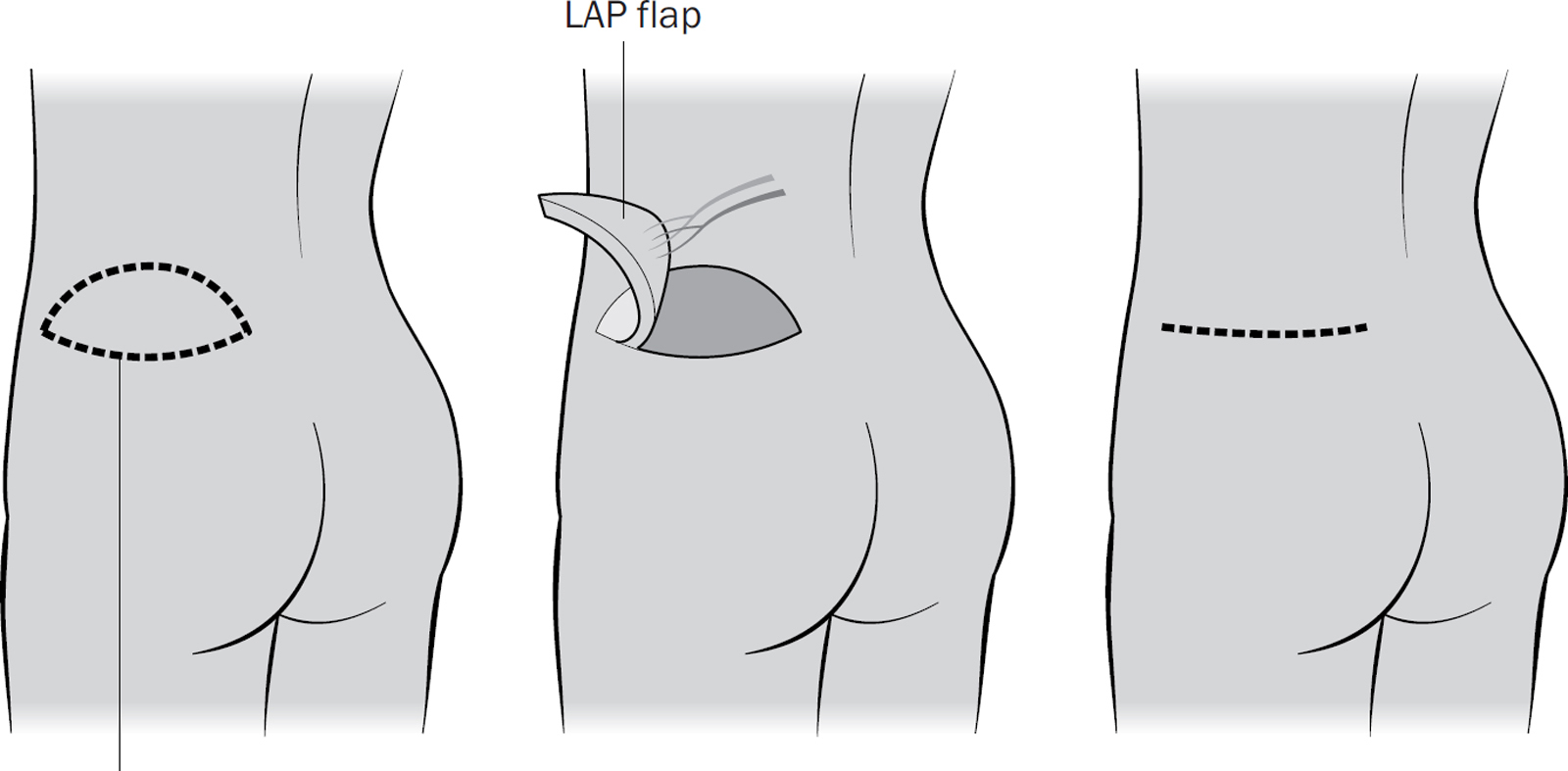 LAP flap reconstruction