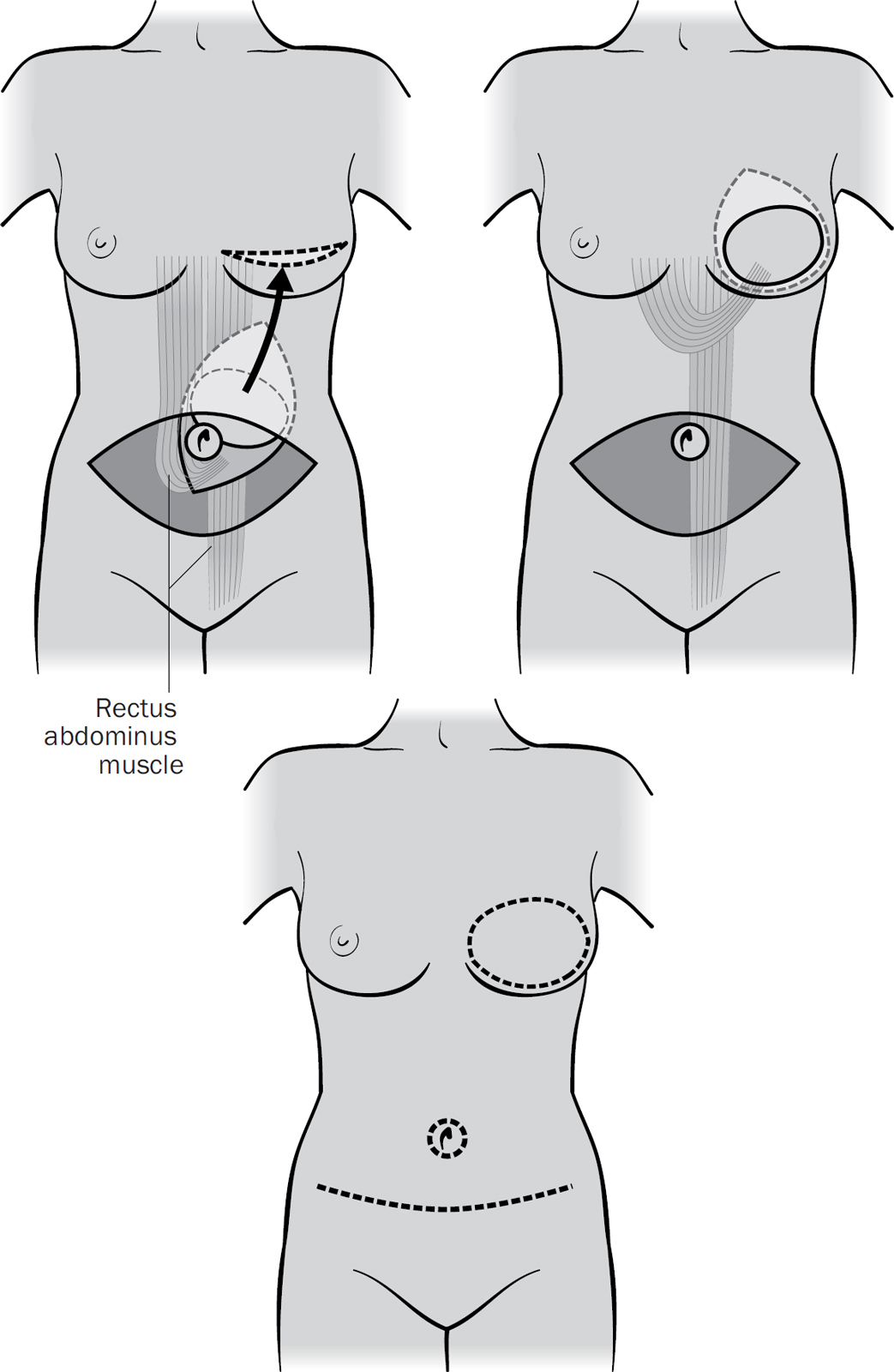 TRAM flap reconstruction