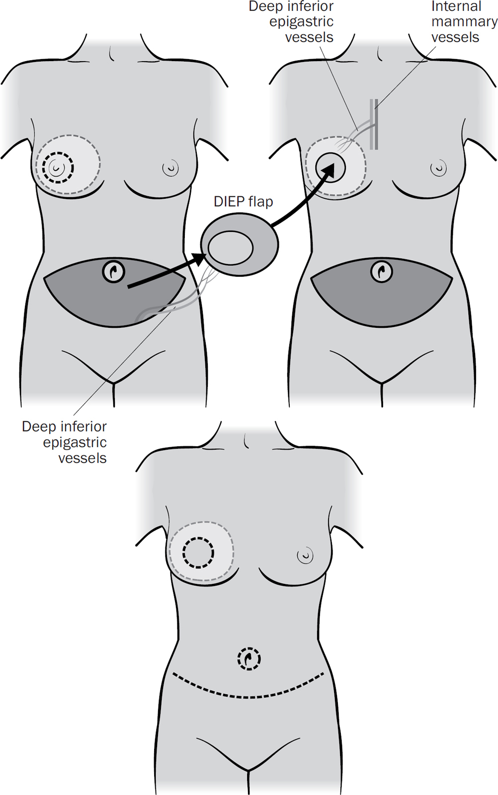 DIEP flap reconstruction