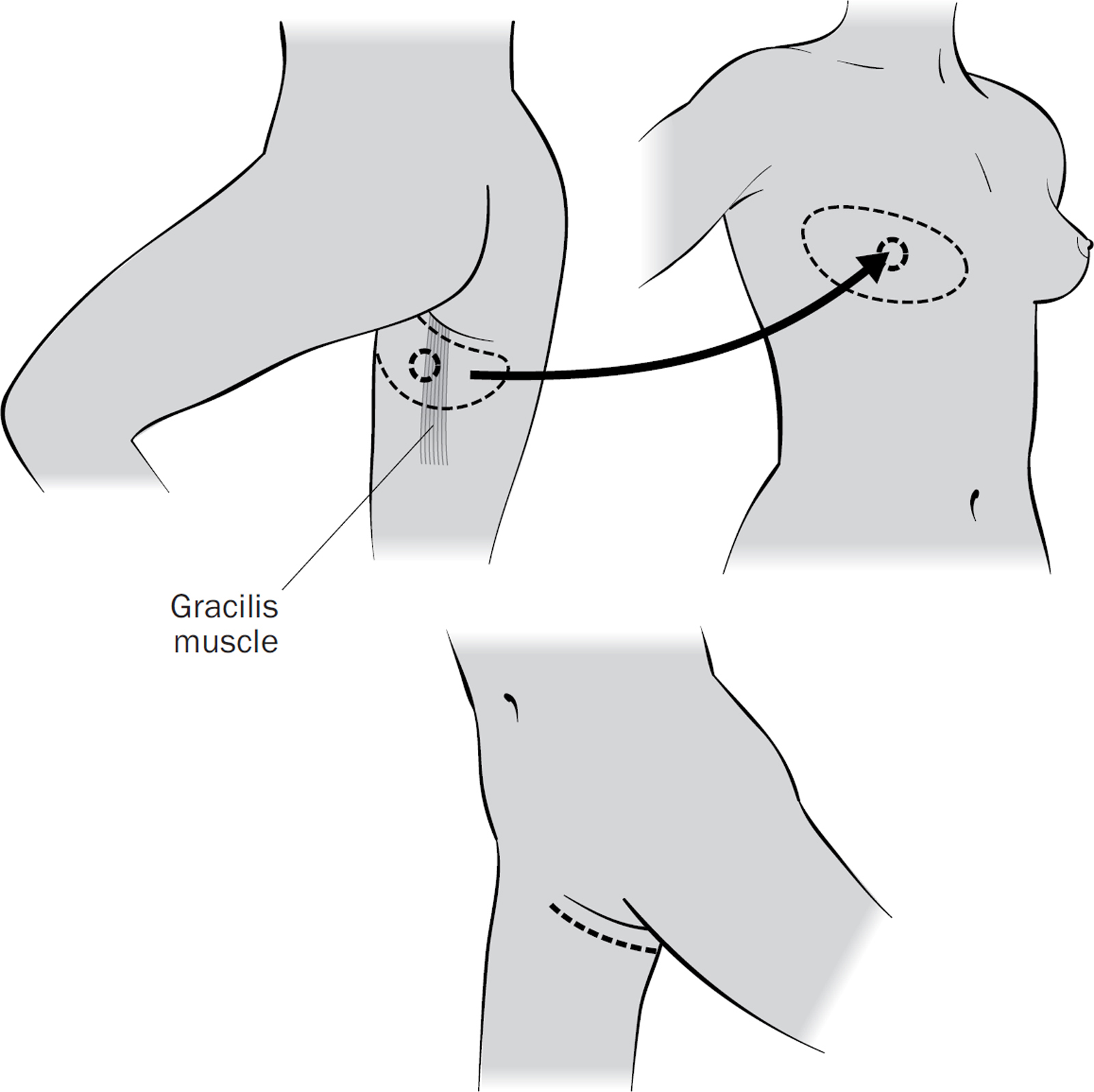 TUG flap reconstruction