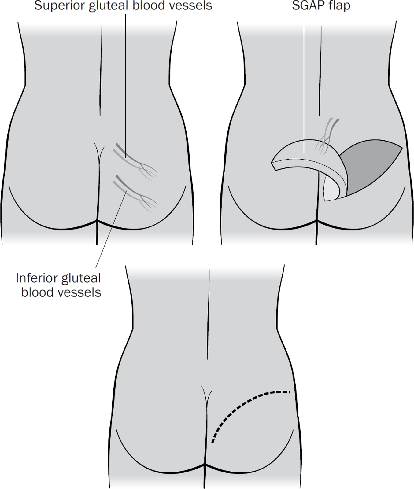 SGAP flap reconstruction