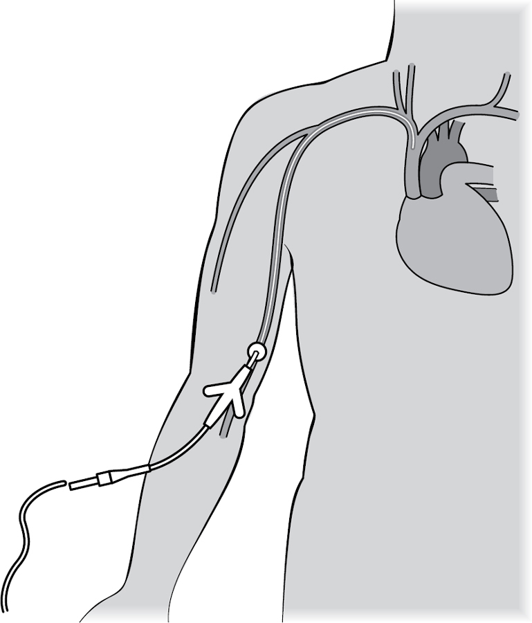 PICC line