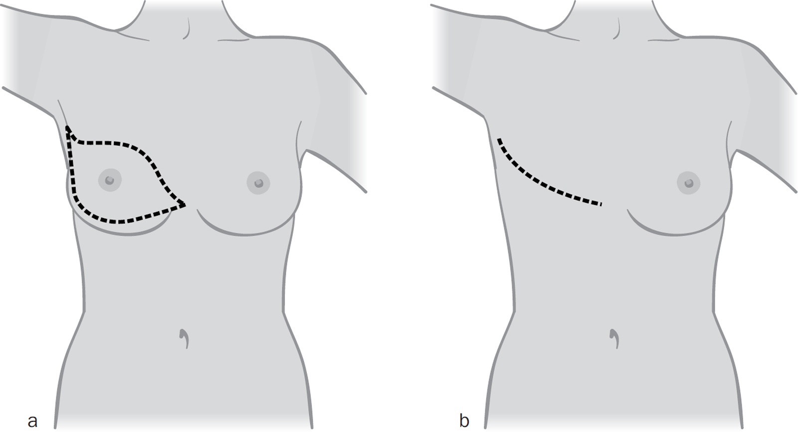 Mastectomy surgery