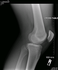 Knee joint, an ellipsoid joint.