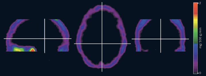 The figure shows an imaging study of the head which indicates an empty skull with surrounded tissue.