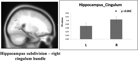 Figure 17.5 Results from FA analysis of a hippocampal section of the cingulum bundle on the left and right, showing higher mean FA in the right cingulum bundle (red).