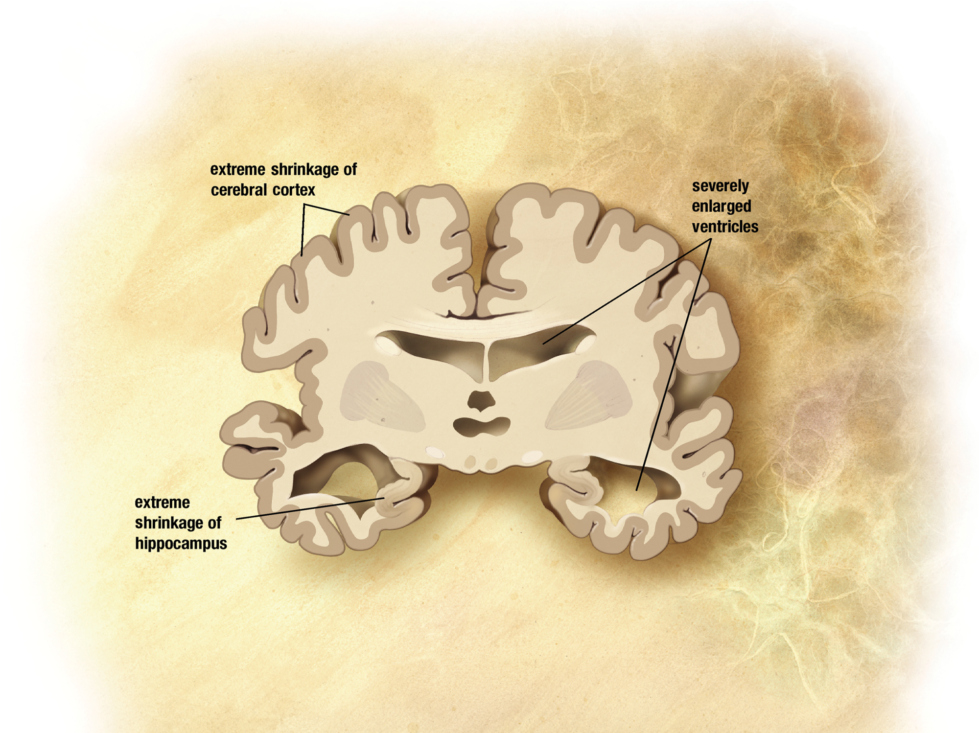 extreme shrinkage of cerebral cortex and hippocampus, enlargement of ventricles