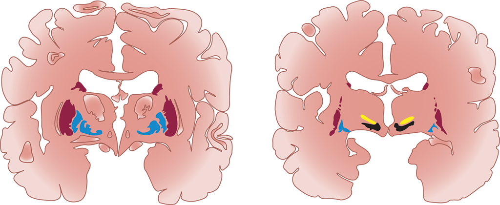 coronal section of brain; substantia nigra is medial and deep, in the top of the brainstem