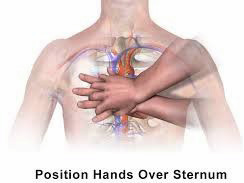 An illustration showing the proper position of your hands over the sternum to perform CPR.