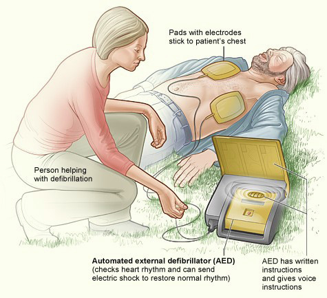 An illustration showing a person helping a heart attack victim with a defibrilator.