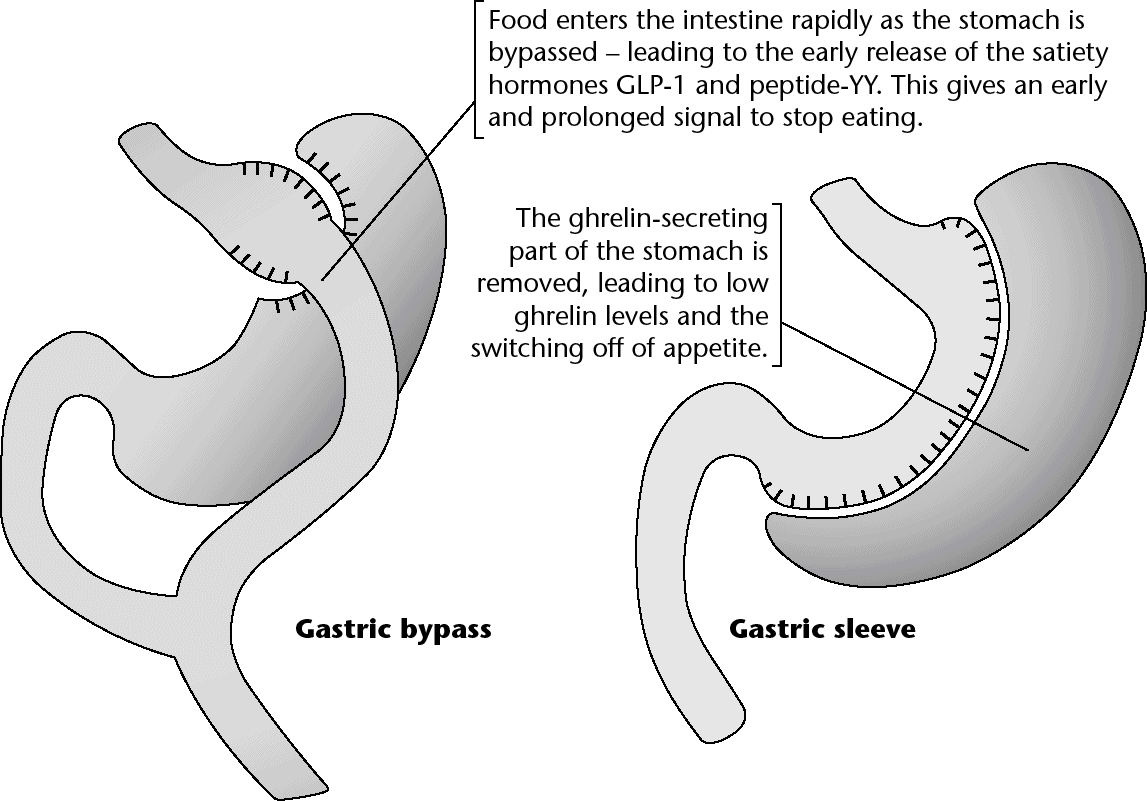 Figure 6.1 The gastric bypass and the gastric sleeve