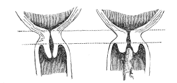 Neck of the Womb