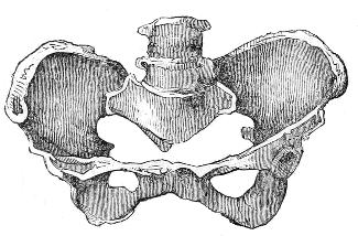 Ovate Pelvis