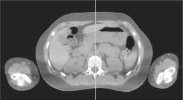 Figure showing Axial CT slice.