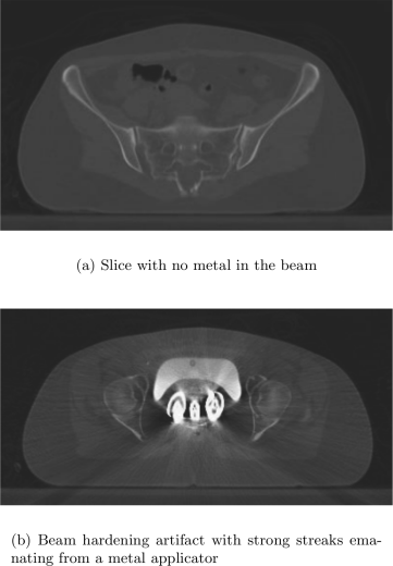 Figure showing Effect of metal artifact.