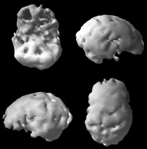 Surface SPECT scan showing areas of very low blood flow.