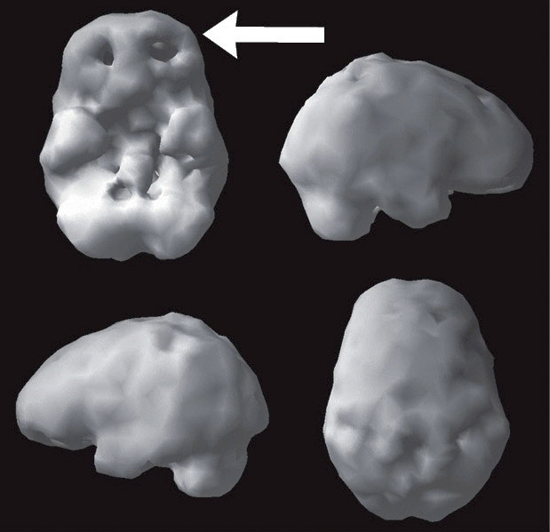 Surface SPECT scan showing areas of very low blood flow.