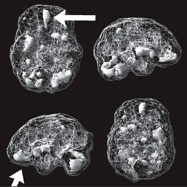 Active SPECT scan showing greater activity in scattered areas, including a wedge-shaped area in the center of the front of the brain.