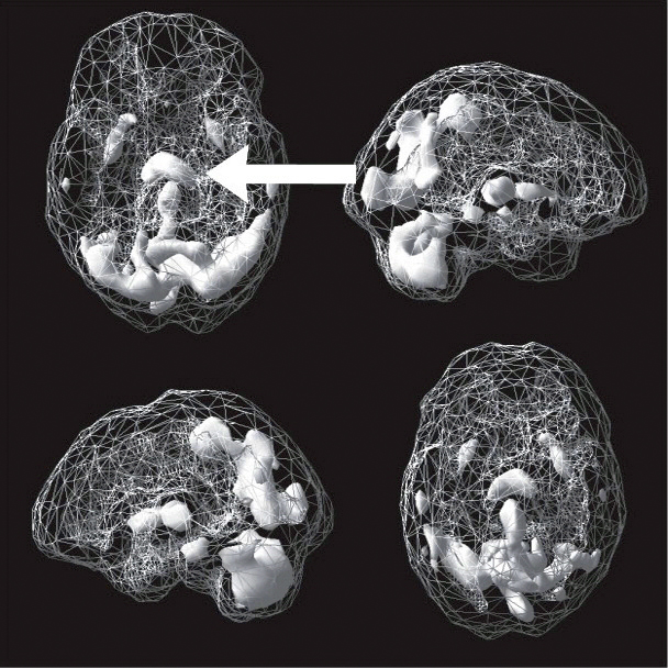 Active SPECT scan showing greater activity in the cerebellum and extending toward the higher middle area of the brain. An arrow points to this area.