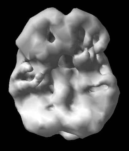 Surface SPECT scan showing areas of very low blood flow.