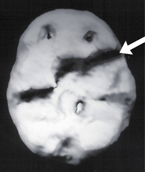 Surface SPECT scan showing areas of very low blood flow.