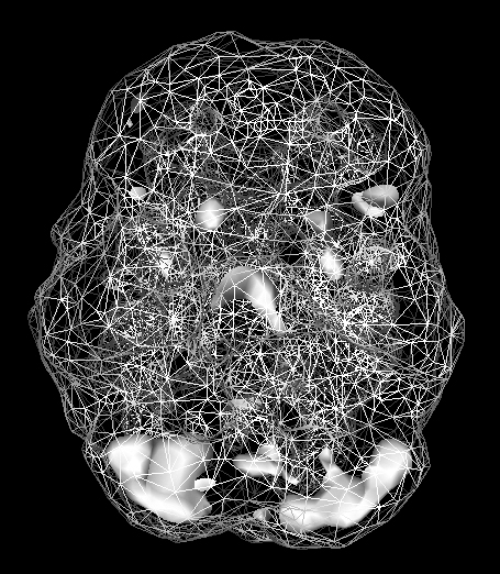 Active SPECT scan showing low activity across the brain.