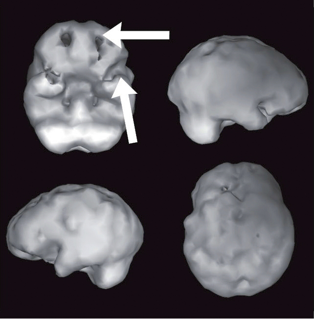 Surface SPECT scan showing areas of very low blood flow.