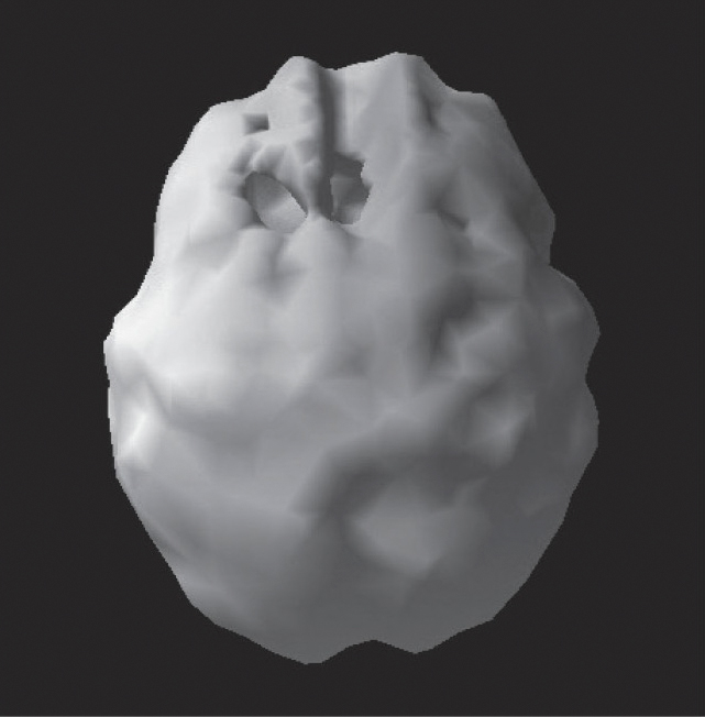 Surface SPECT scan showing more uniform blood flow.