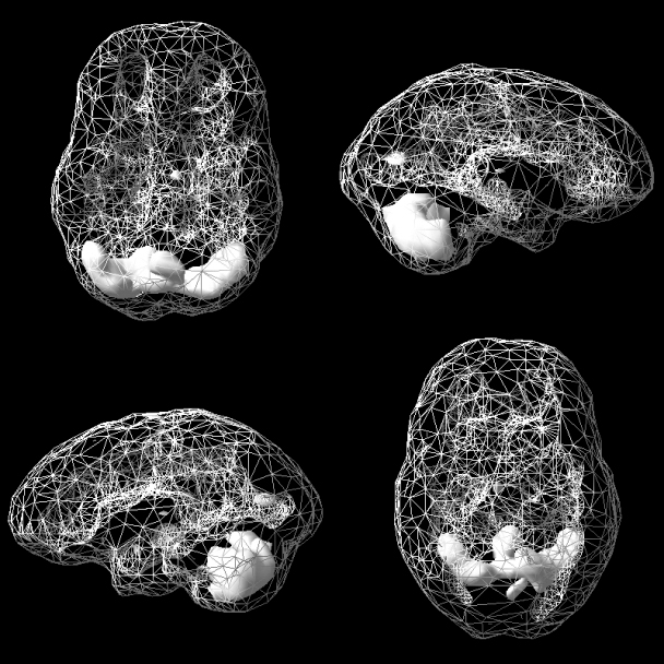 Active SPECT scan showing greater activity in the cerebellum.